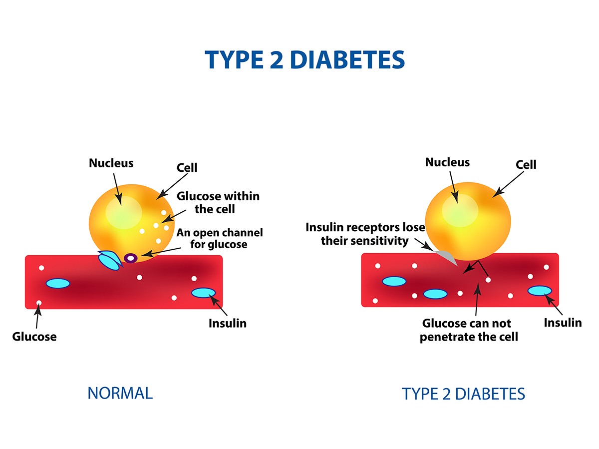 type 2 diabetes